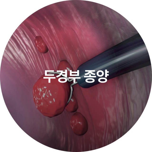 두경부 종양