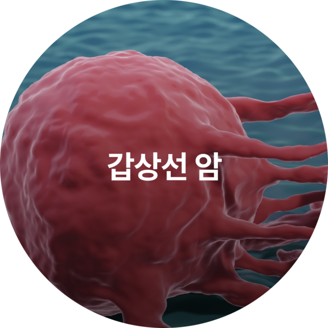 갑상선 암