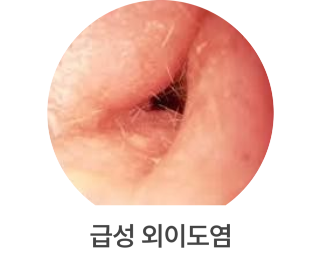 급성 외이도염