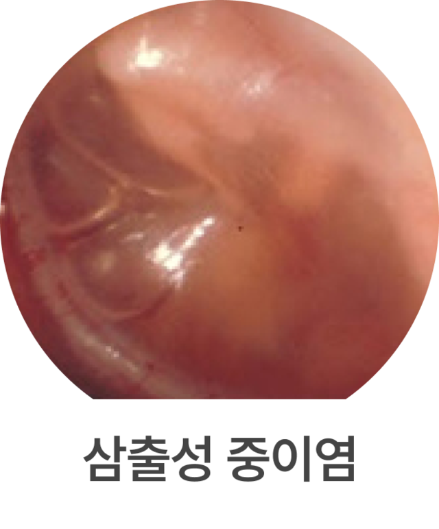 급성 중이염