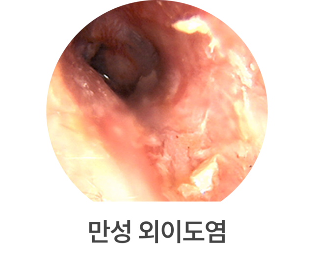 만성 외이도염