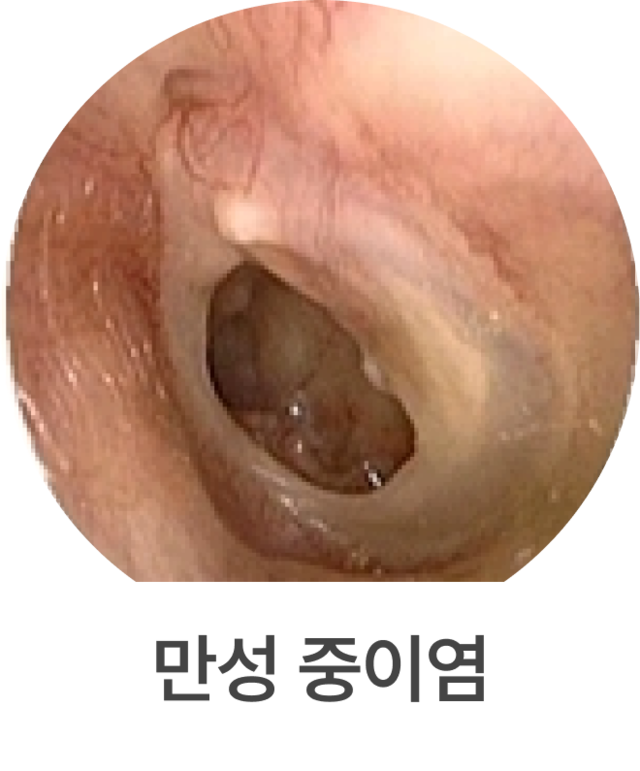 만성 중이염