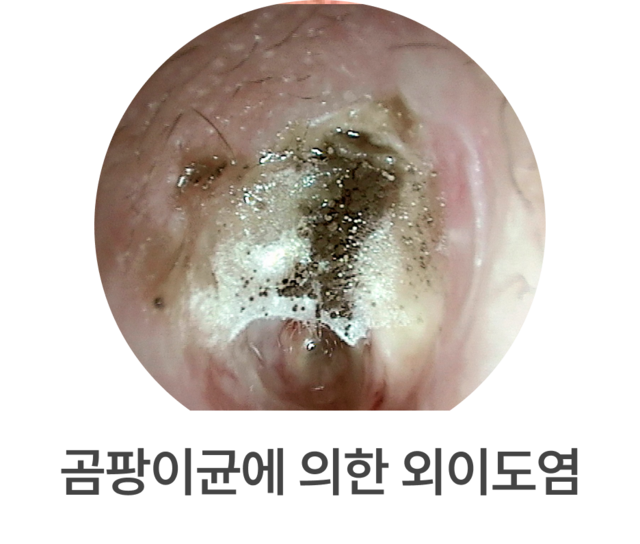 곰팡이 외이도염