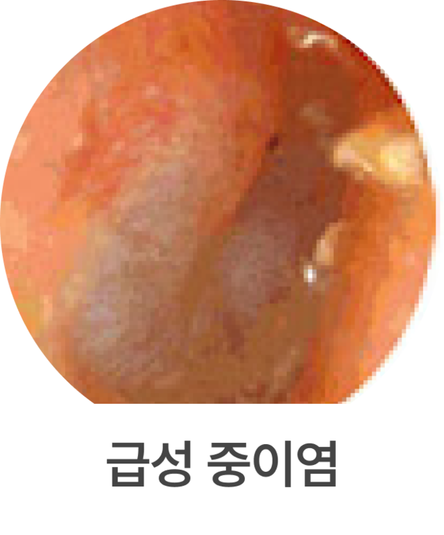 삼출성 중이염