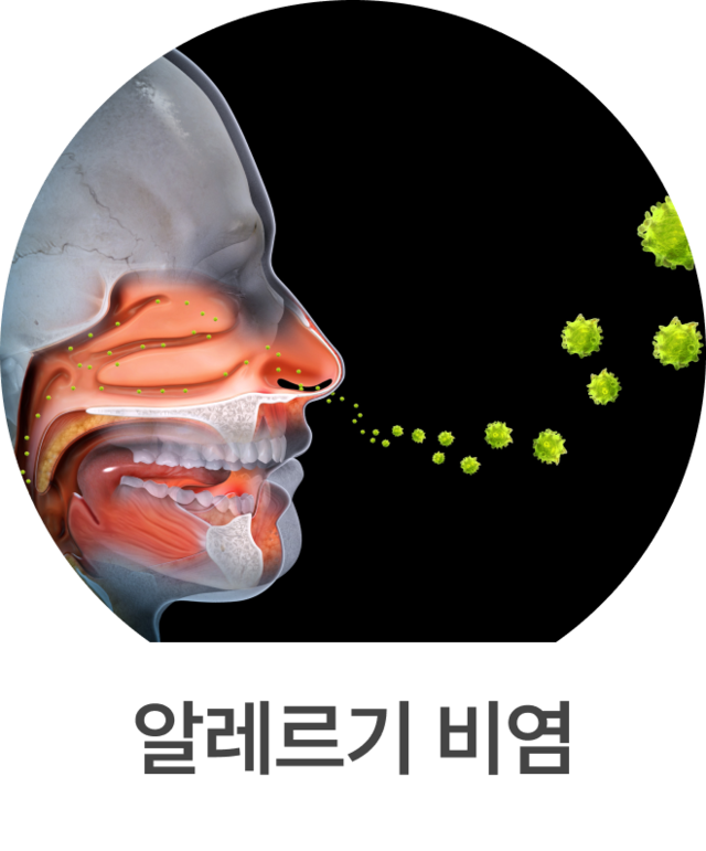 알레르기 비염